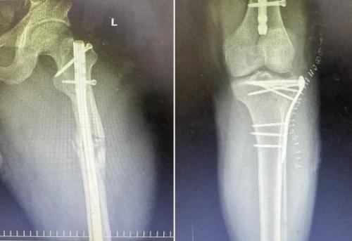 沈阳六院骨二科为单侧股骨干、胫骨平台粉碎性骨折患者成功实施手术