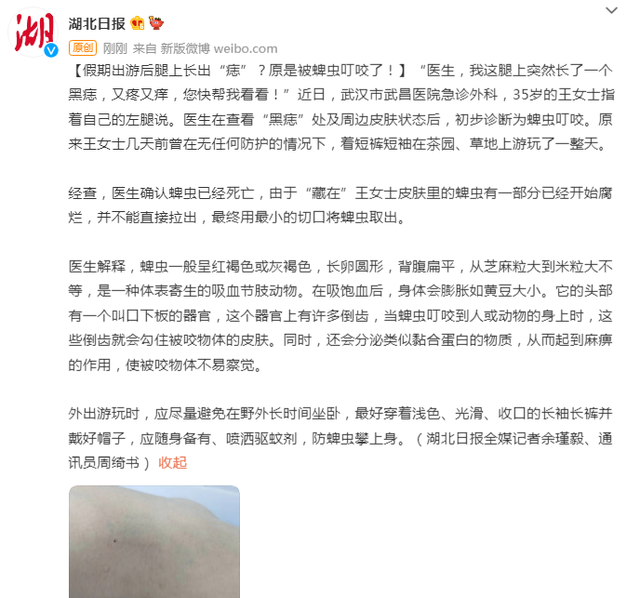 假期出游后腿上长出“痣”？原来是被蜱虫叮咬了